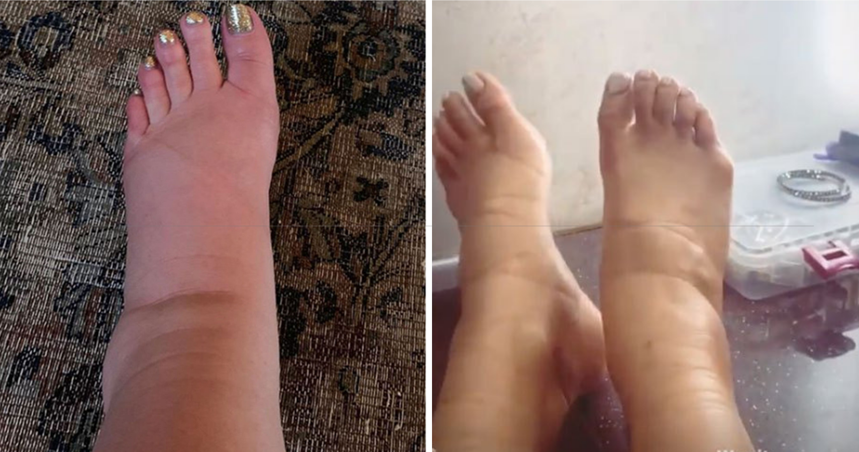 pain-in-feet-from-swelling-during-pregnancy-at-yoshiko-lee-blog