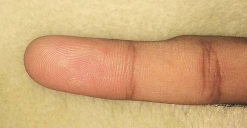 Featured image of post Smartphone Pinky - Simply using your smartphone can be twitter users have been sharing photos of how their pinky fingers are bent, dented, and deformed.