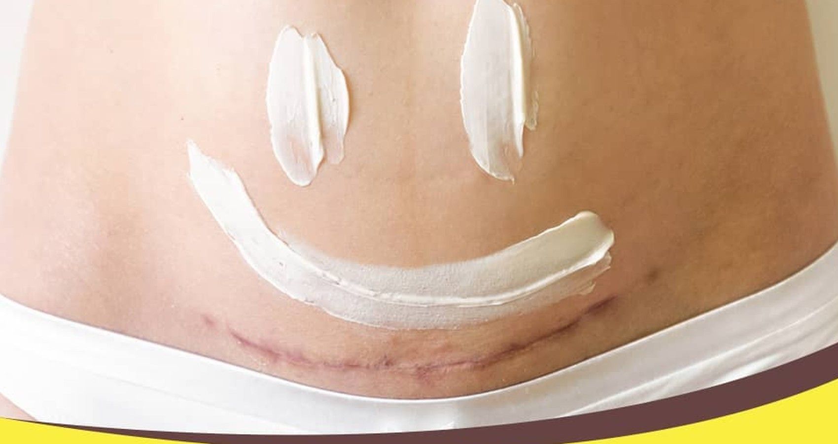 A c-section scar with a happy face in cream over top