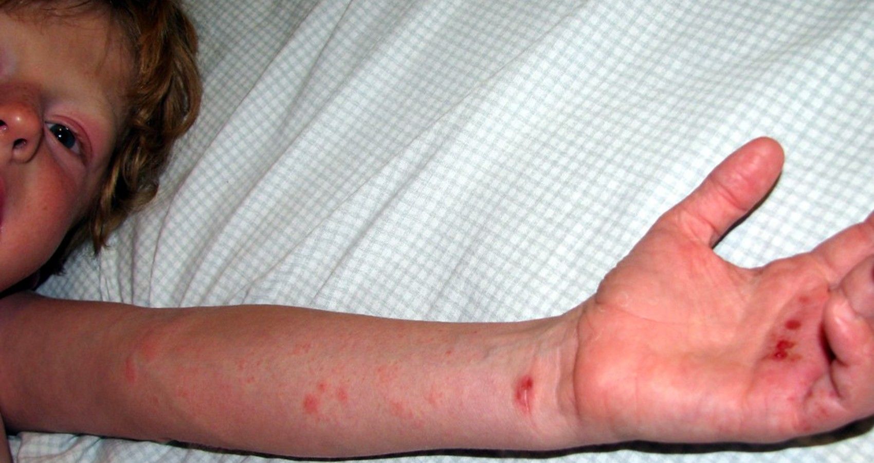 Kids' Severe Eczema Linked To Depression