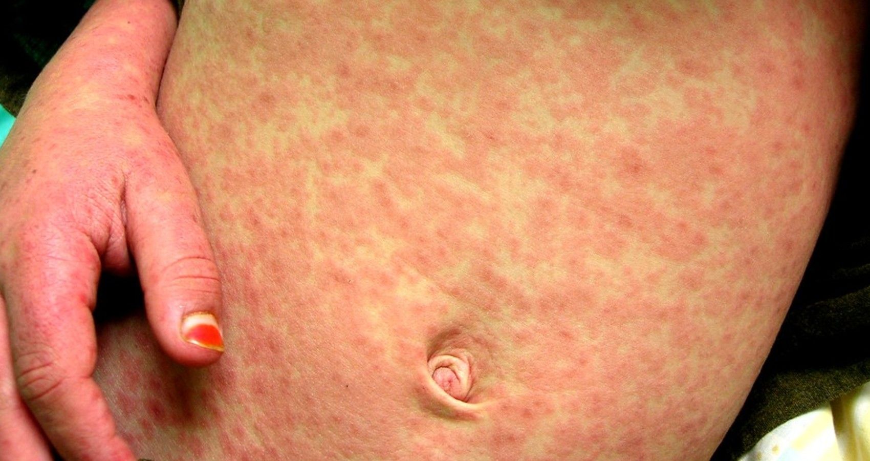 Measles Cases Are Up 80% In 2022